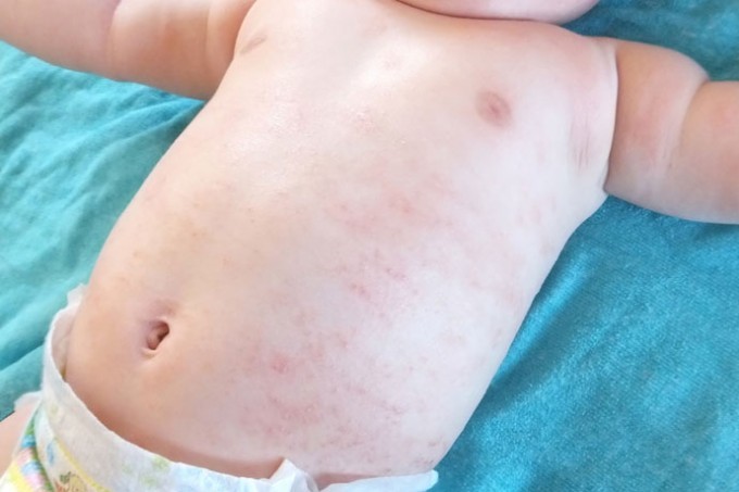 このぶつぶつ何 子どもが発疹を出す原因と病院を受診するタイミング ファンファン福岡